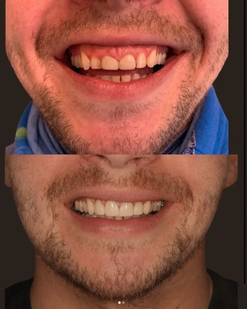 Before & after treatment with Morven
