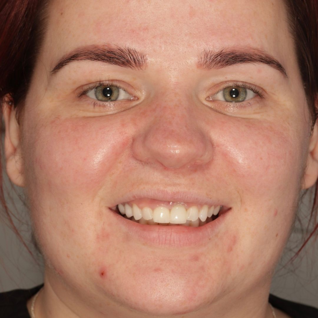 After dental implant treatment with Morven