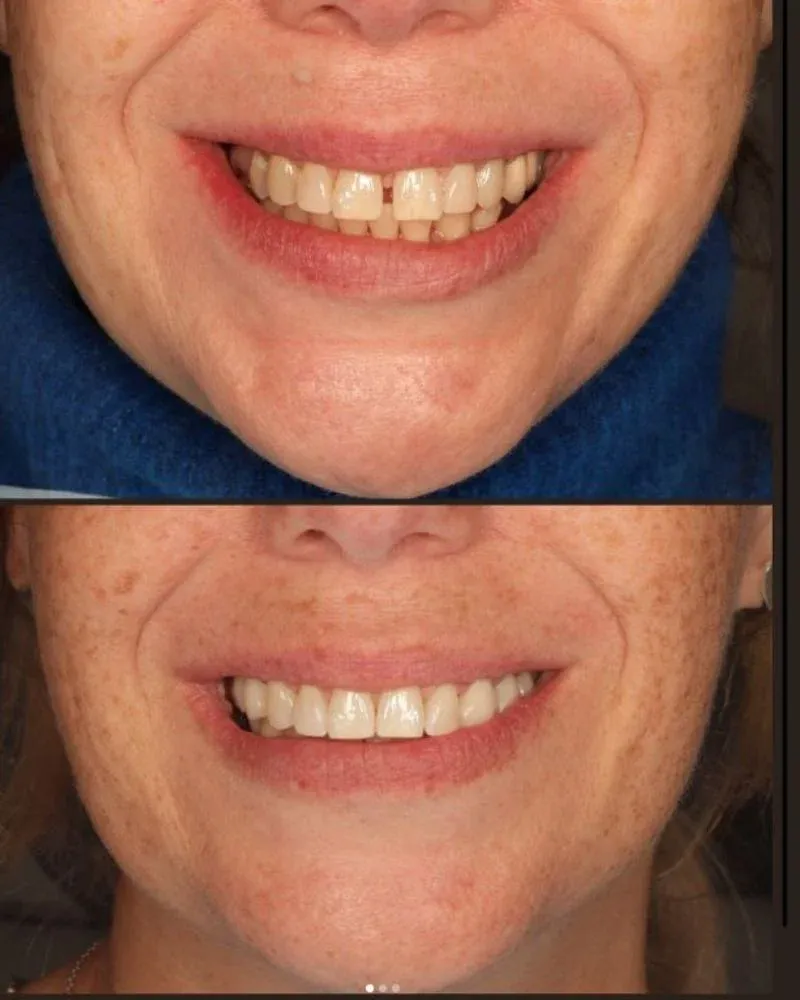 Before & after treatment with Morven
